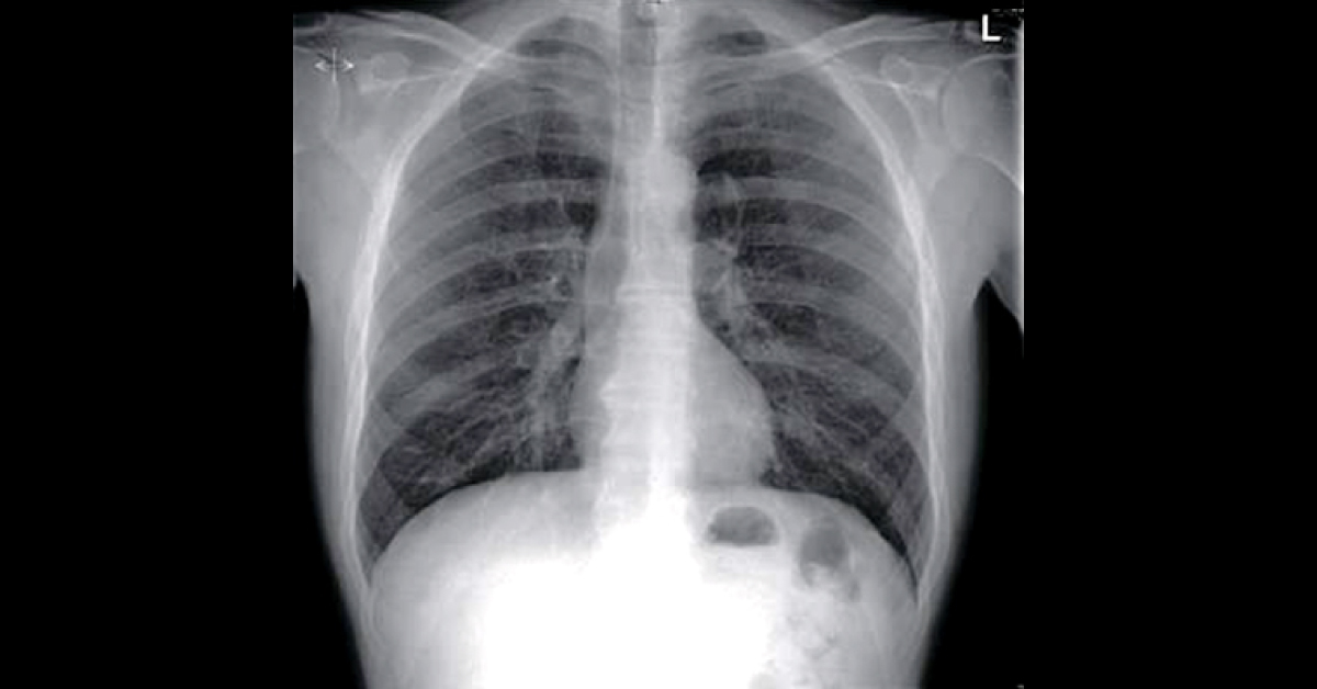 Identify This Drug Induced Condition