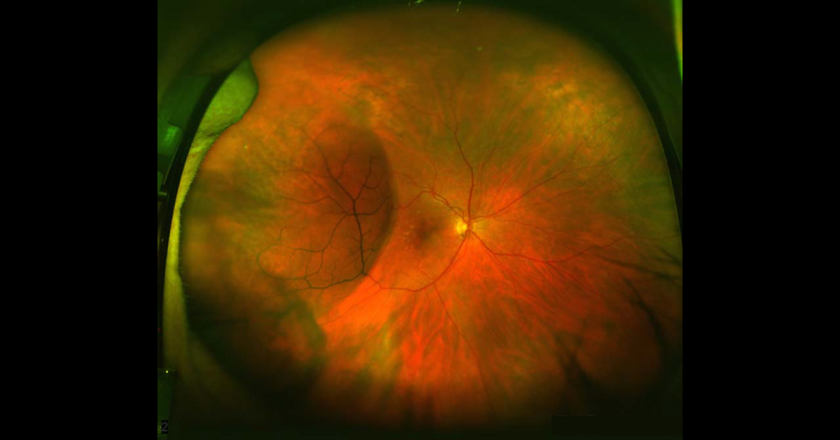 Identify This Ophthalmic Condition