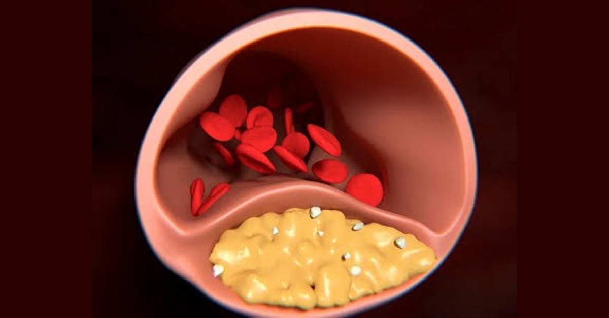 Milking Effect In CAG- An Indication For Myocardial Bridge