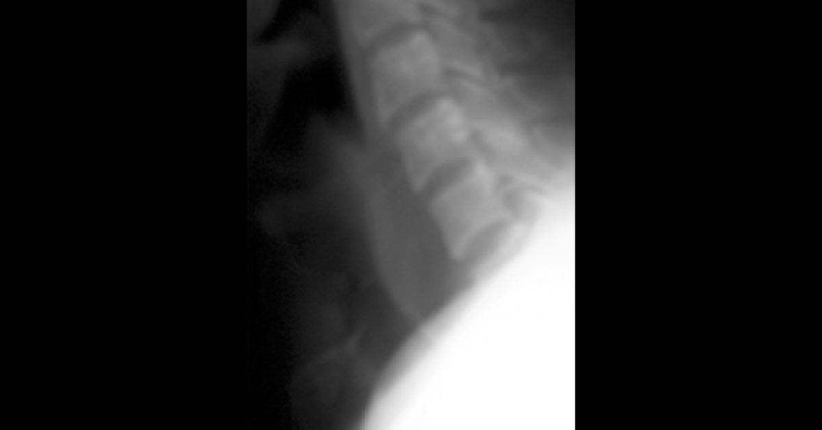 Resolve The Case Of Dysphagia
