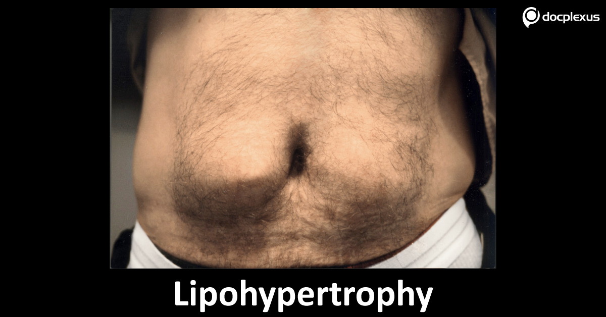 Lipohypertrophy, Causes And Treatment