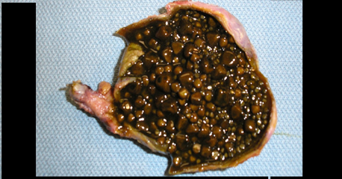 Site For Impaction Of Gall Stones