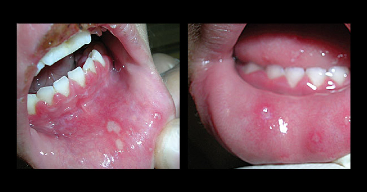 Diagnose Cause Of Gingival Bleeding