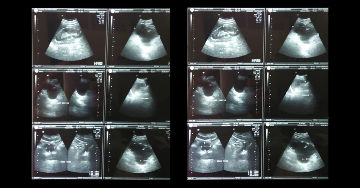 Ballooning Of Left Kidney Congenital Or Acquired