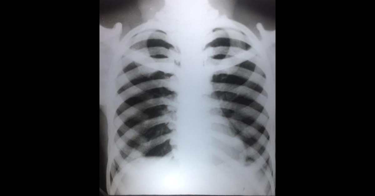 What Is This Bone Disease? 