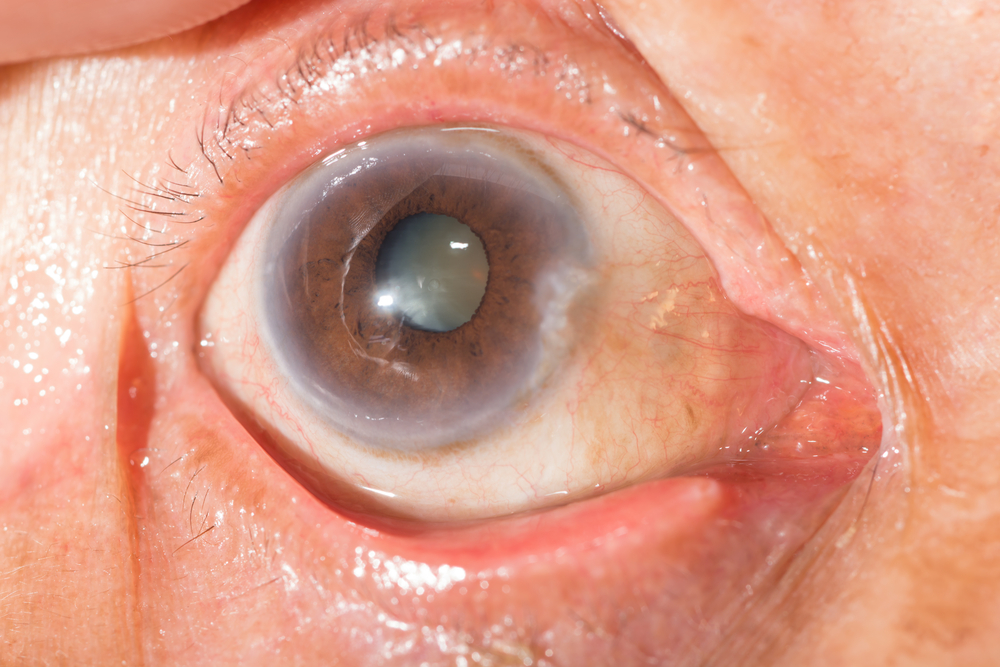 Cataracts Affect Sleep And Cognitive Function, Says A Recent Study In Japan