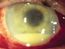 NHRC Orders FIR Against Eye Hospital For Infection