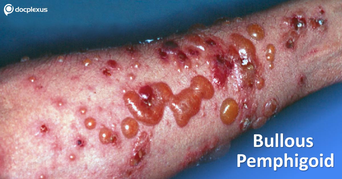 Bullous Pemphigoid: Management Guidelines By British Association Of Dermatologists