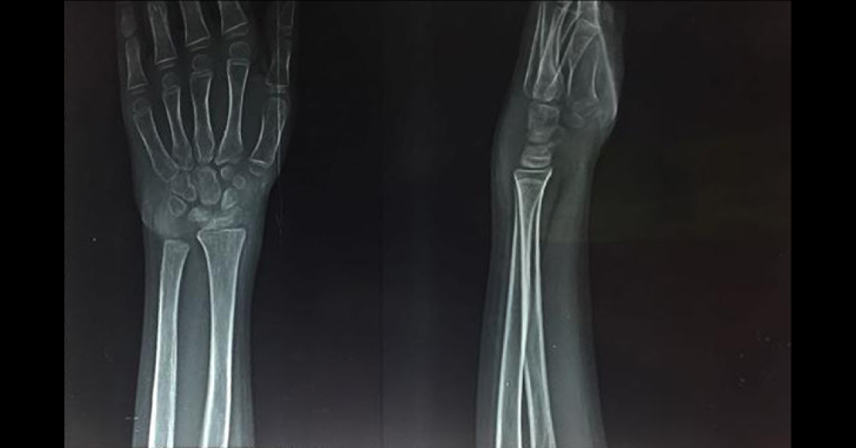 What Happened To His Left Hand? Part 2