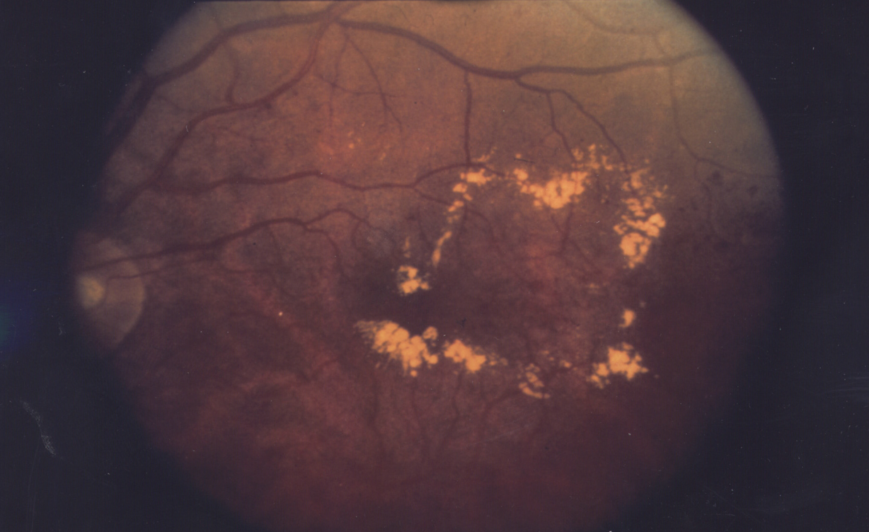 Diabetic Macular Edema: Royal college of ophthalmologists, Diabetic Retinopathy Guidelines (2012)