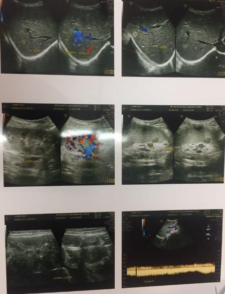 Can It Be Small Splenic Abscesses?