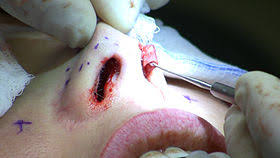 Rhinoplasty, Nose Job/nose Reshaping