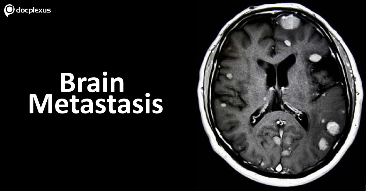 Management Of Brain Metastasis