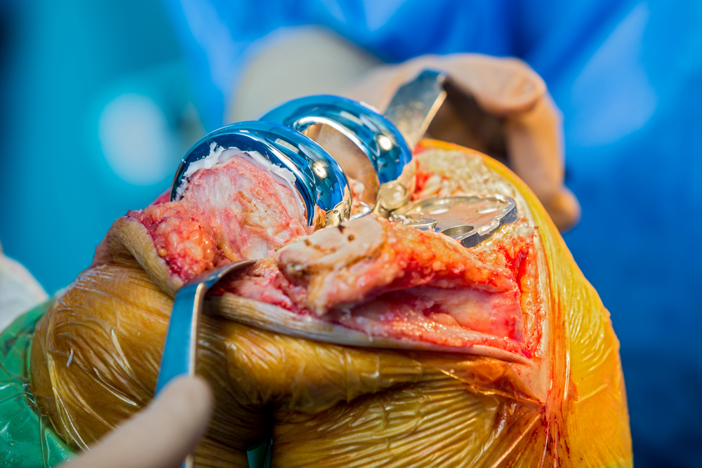 Pre Operative TKR Success Prediction, And Outcome Measurement Algorithms