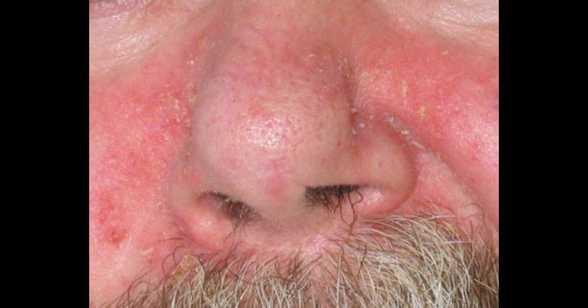 What Is This Skin Rash