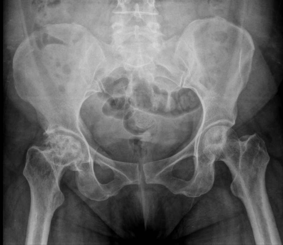 What Could Be The Etiology Of This AVN Right Hip ?