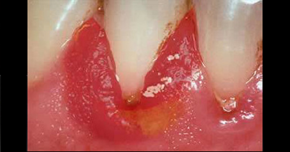 What Is This Dental Condition?