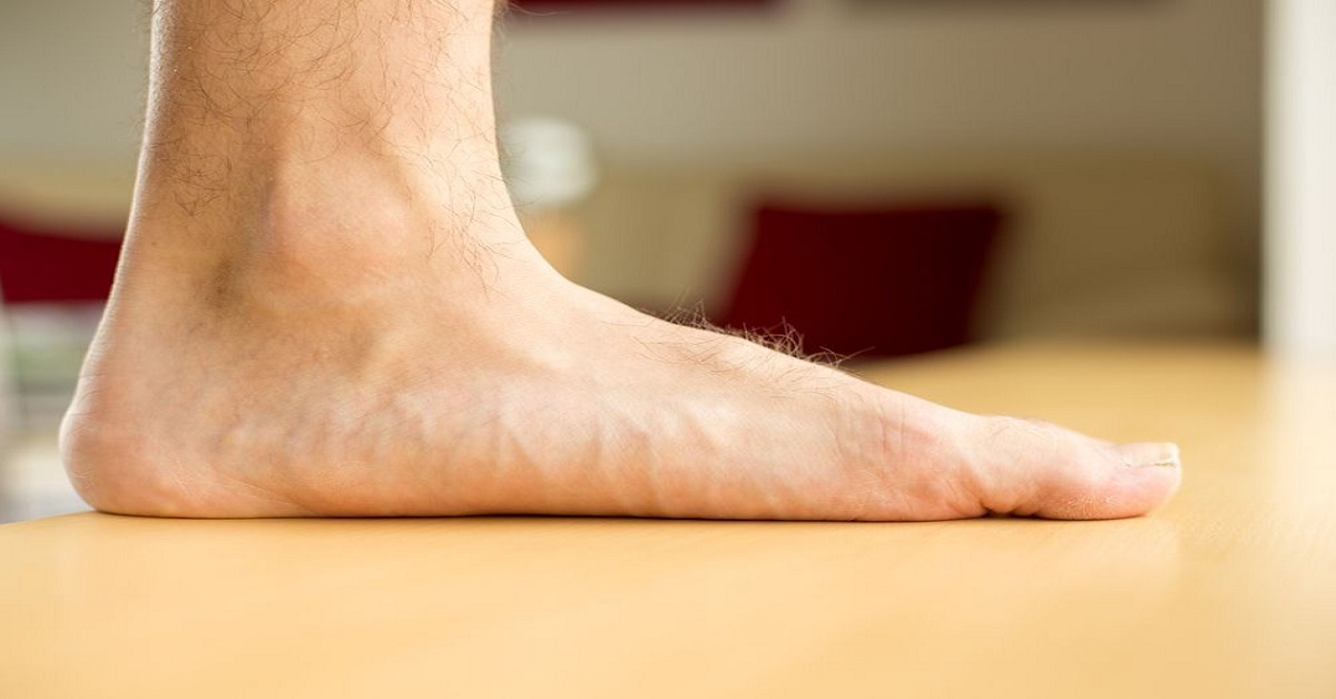 Overview Of Flat Feet Condition