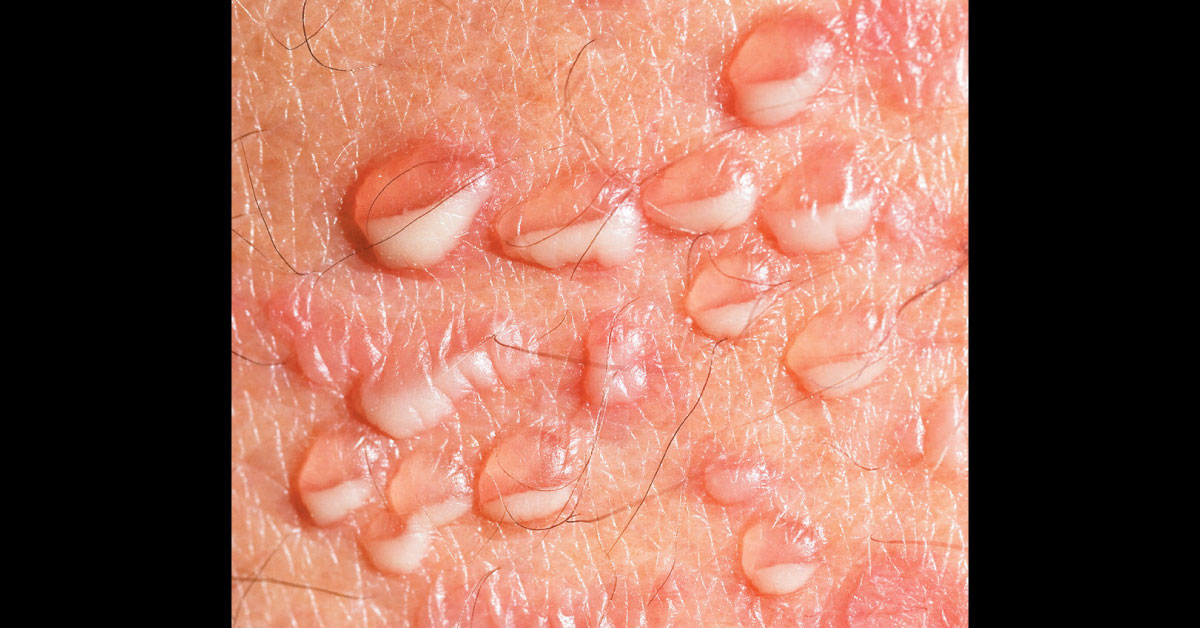 Identify This Dermatological Condition