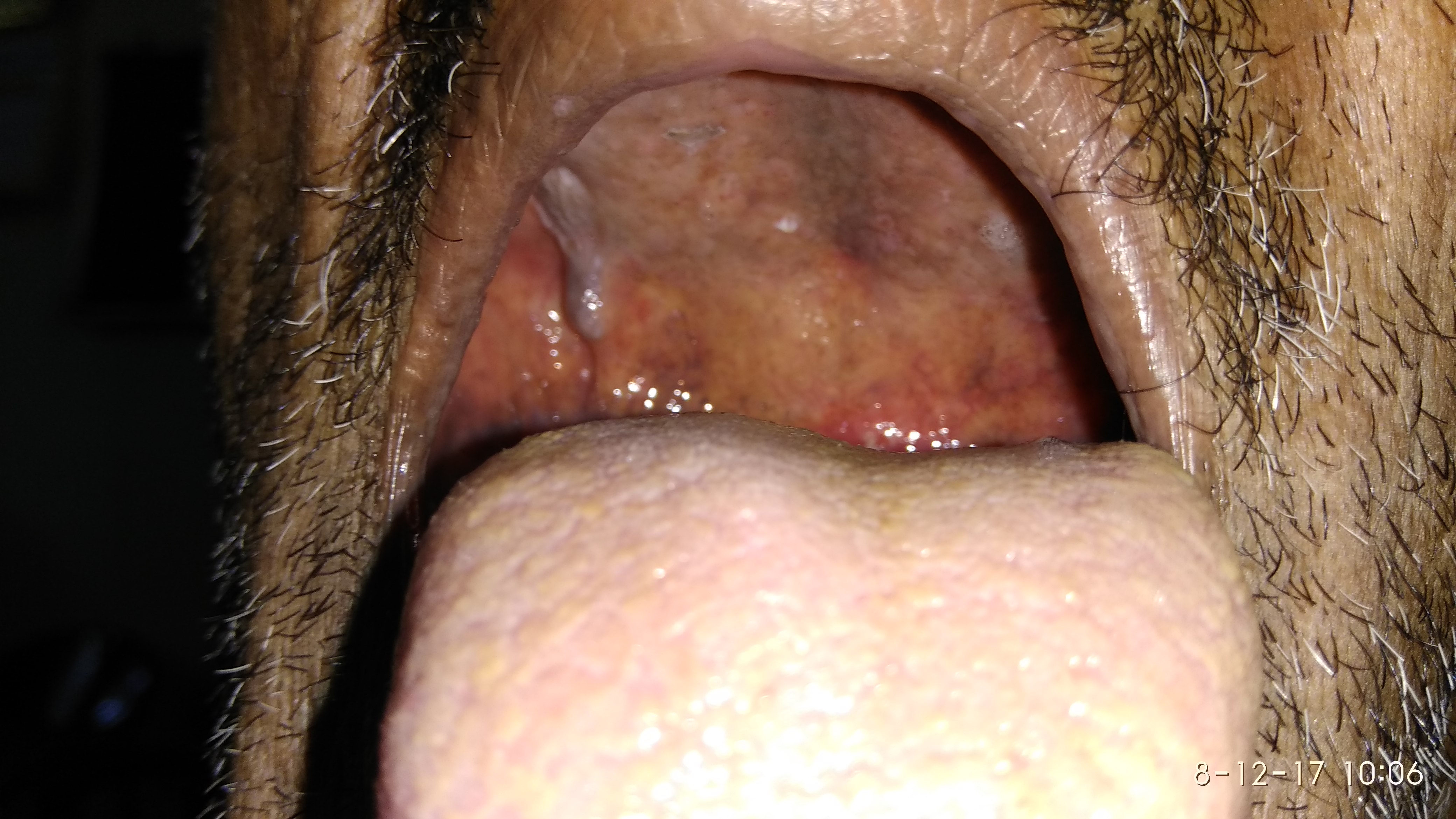 Palatal Erythema, Ulcer And Pain In Ear