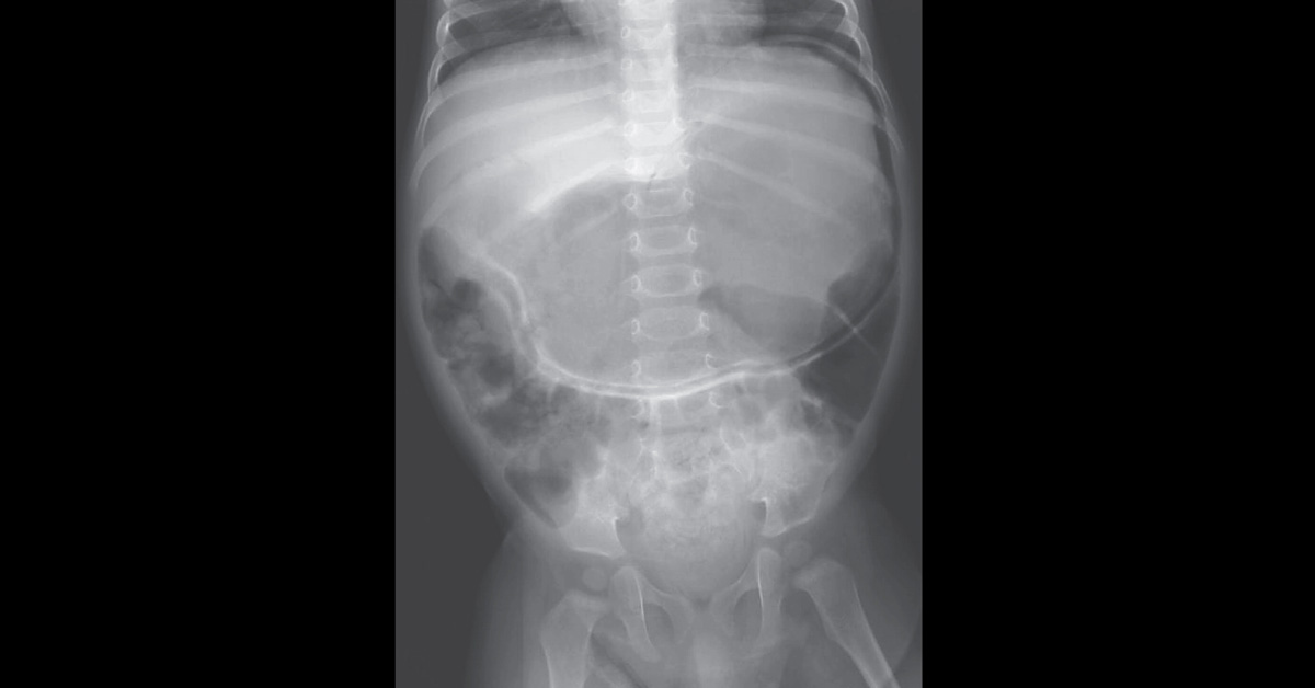 Identify This Condition In A Baby
