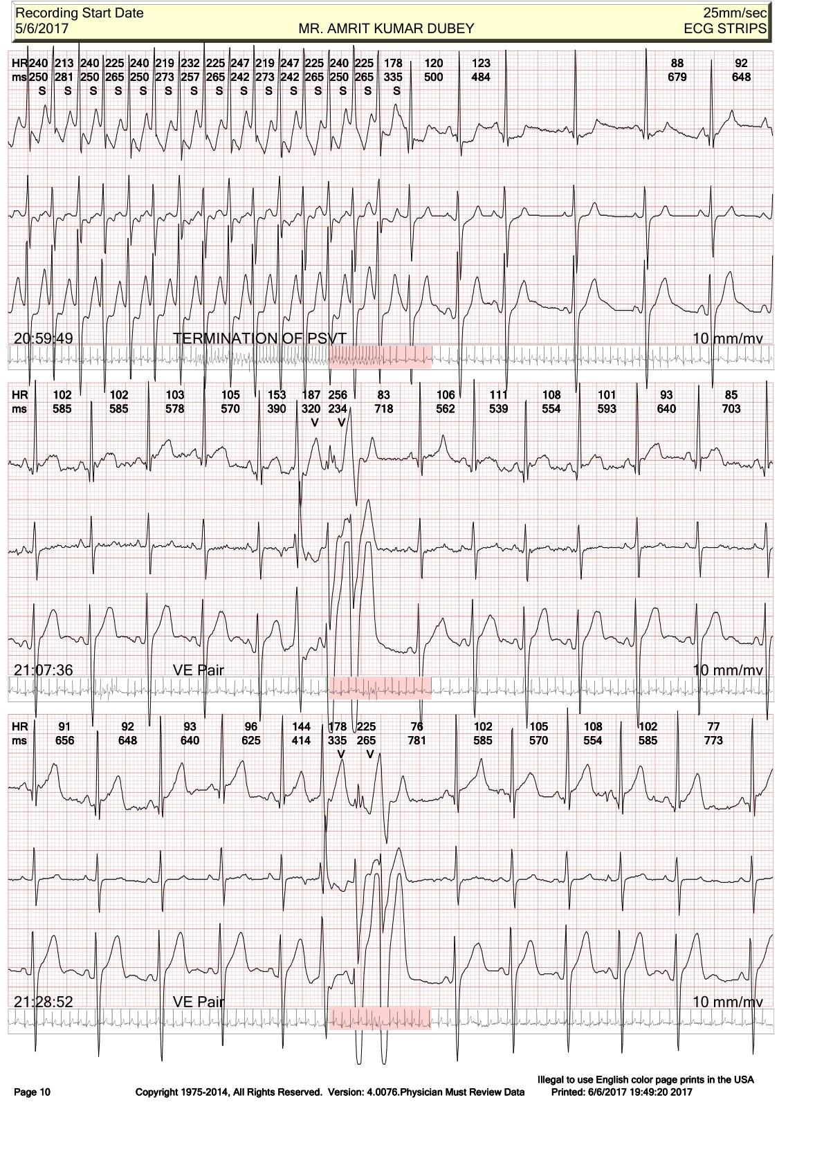 Arrhythmia In A Young Boy