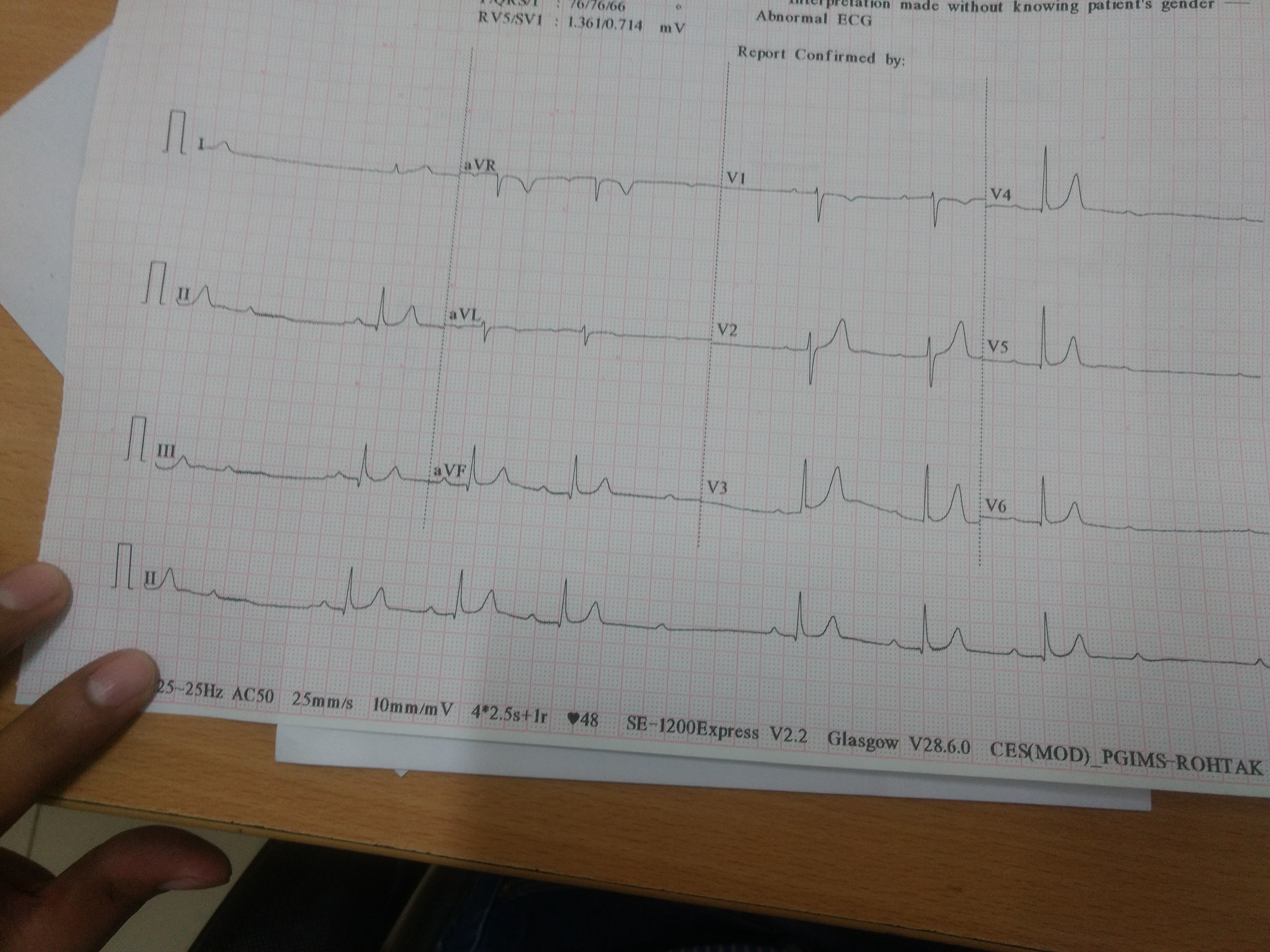 2nd Degree Heart Block