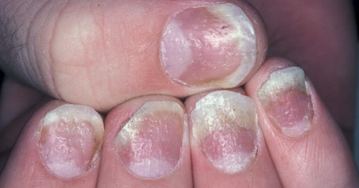 Treatment Options For Nail Psoriasis