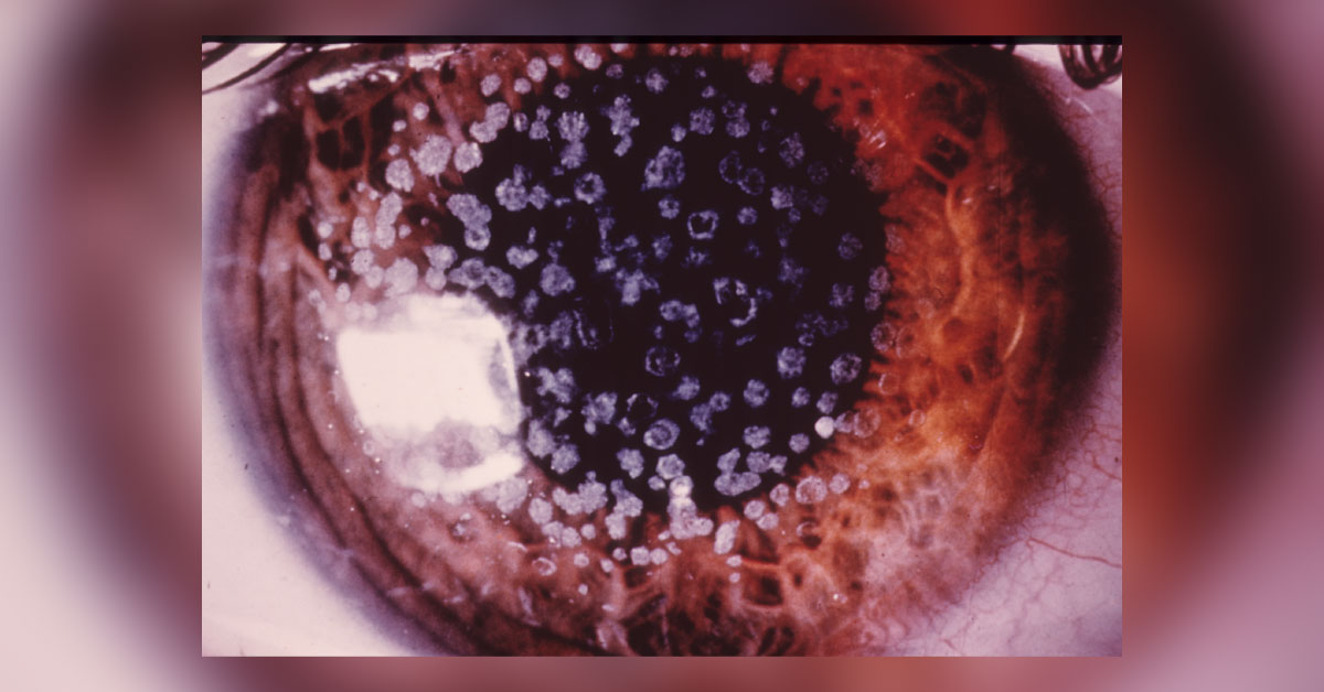 Ophthalmology Spot Diagnosis