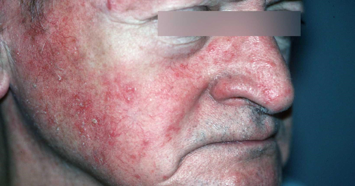 Treating Geriatric Dermatoses