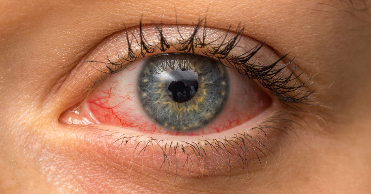 A Quick Guide For Efficient Red Eye Evaluation