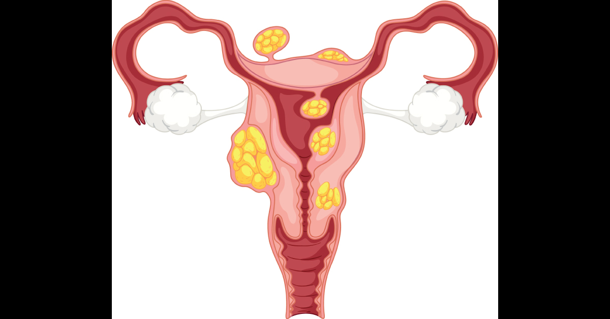Uterine Fibroid And Miscarriage Link Disputed