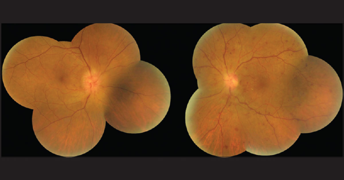 Solve This Ophthalmology Case