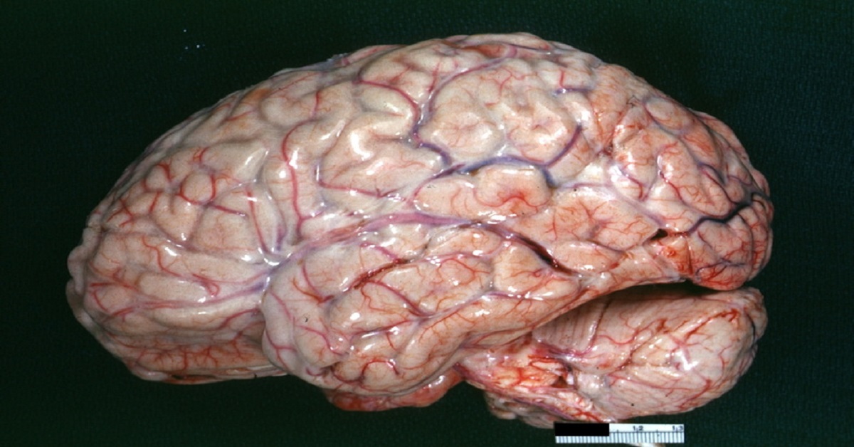 Challenges In The Management Of Tuberculosis Meningitis