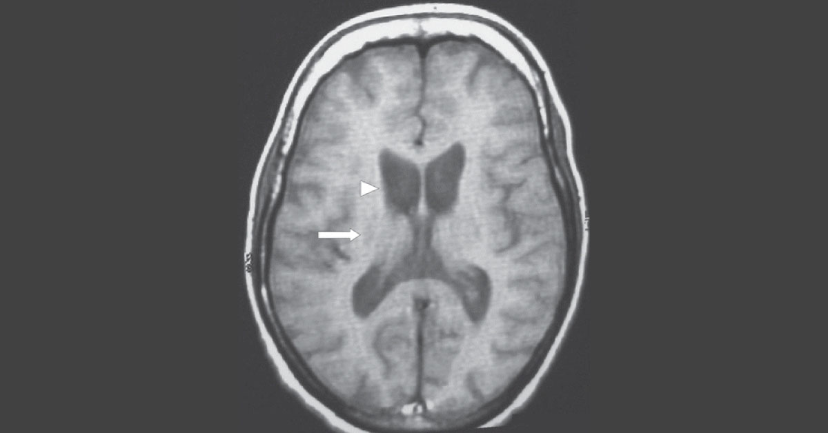 Identify This Neurological Condition