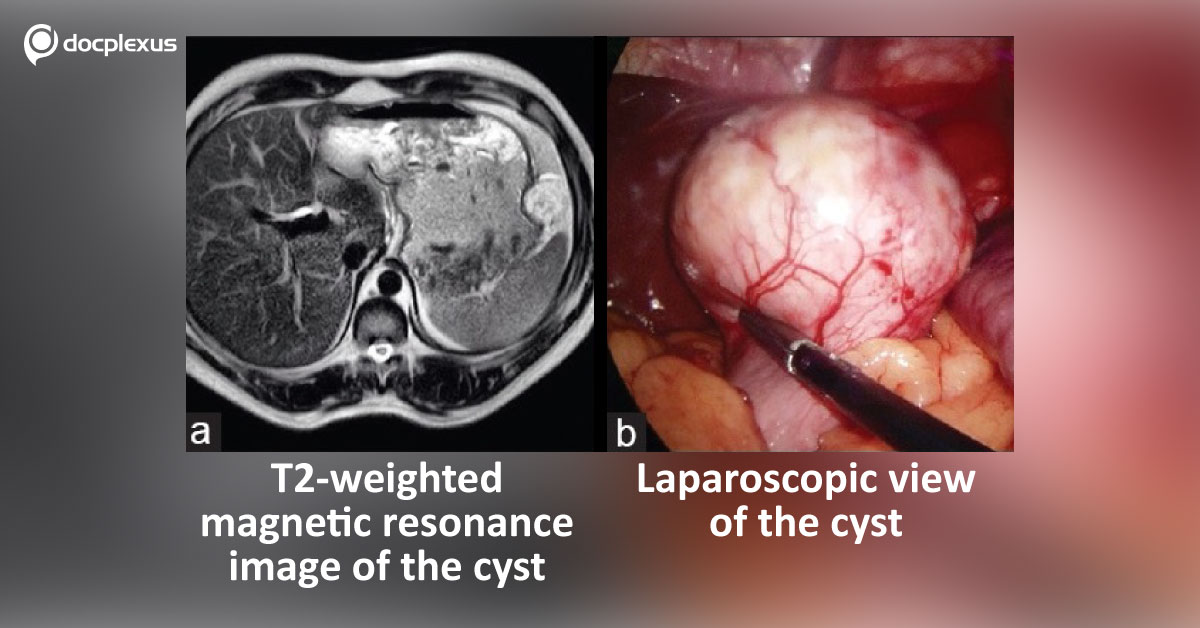 Adult Gastric Duplication Cyst, Challenge For Surgeons