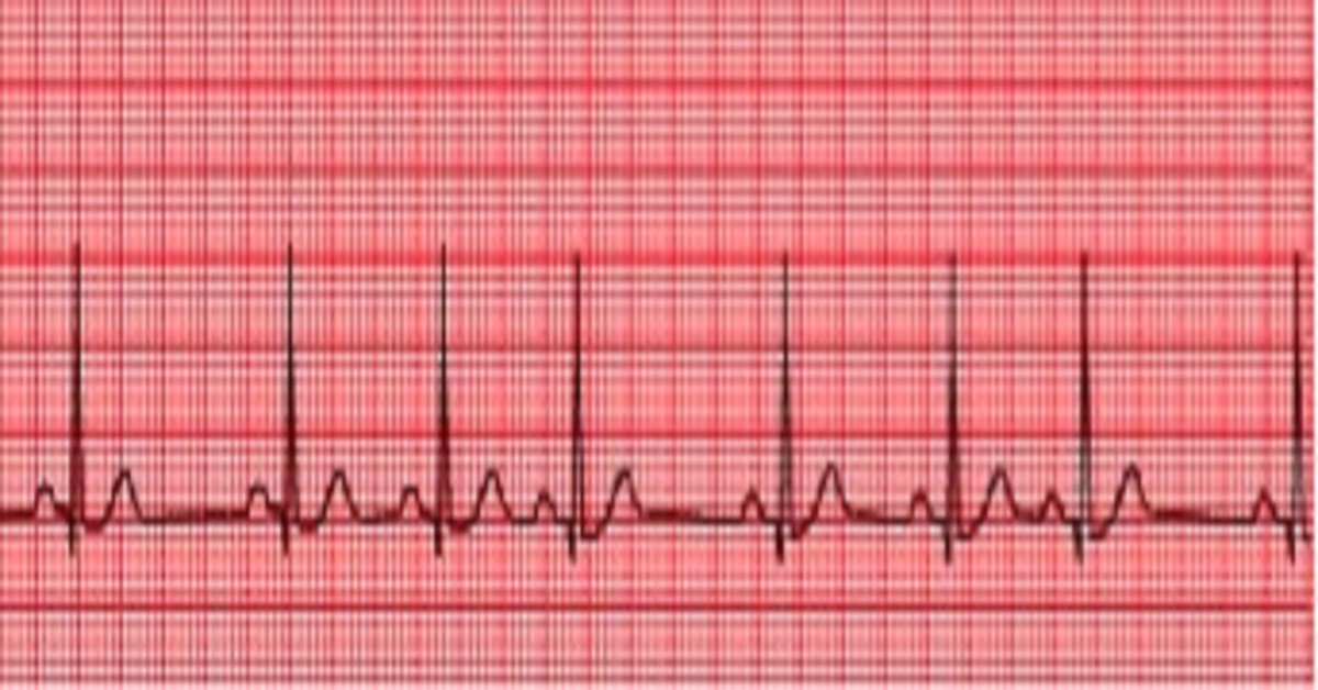 Interpret This Ecg