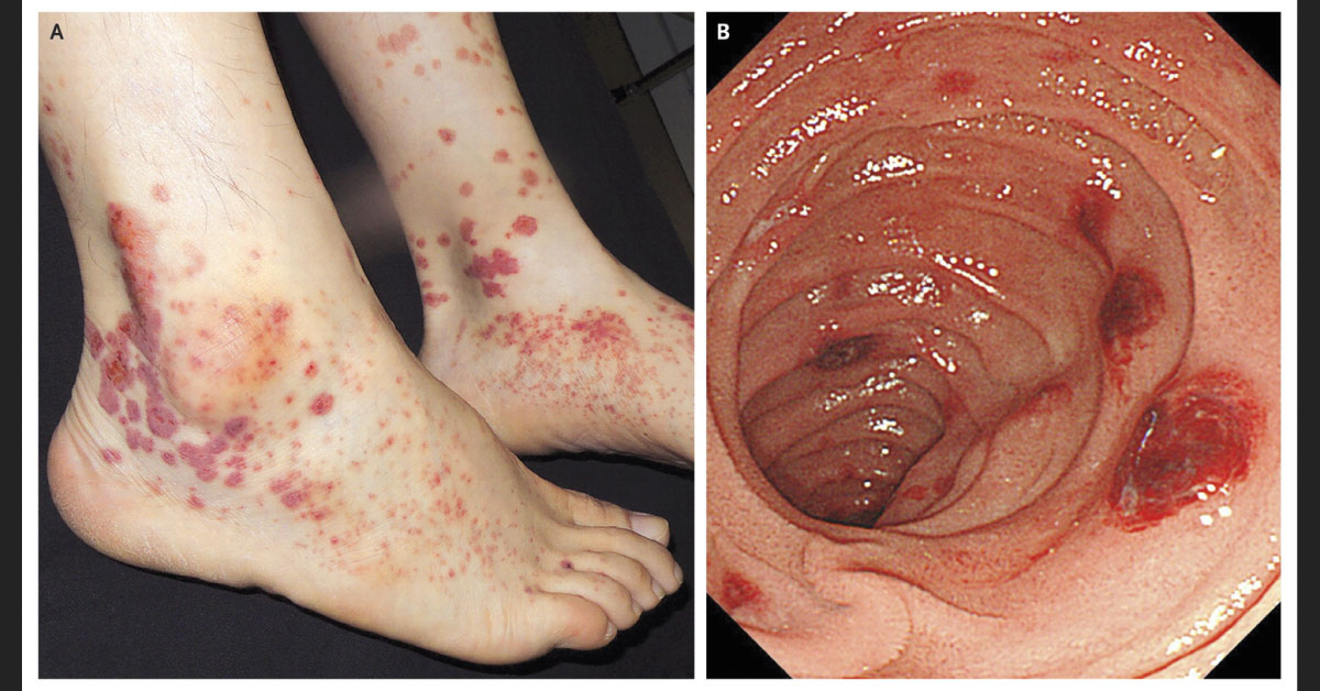 Palpable Purpura In The Lower Extremities And Abdominal Pain