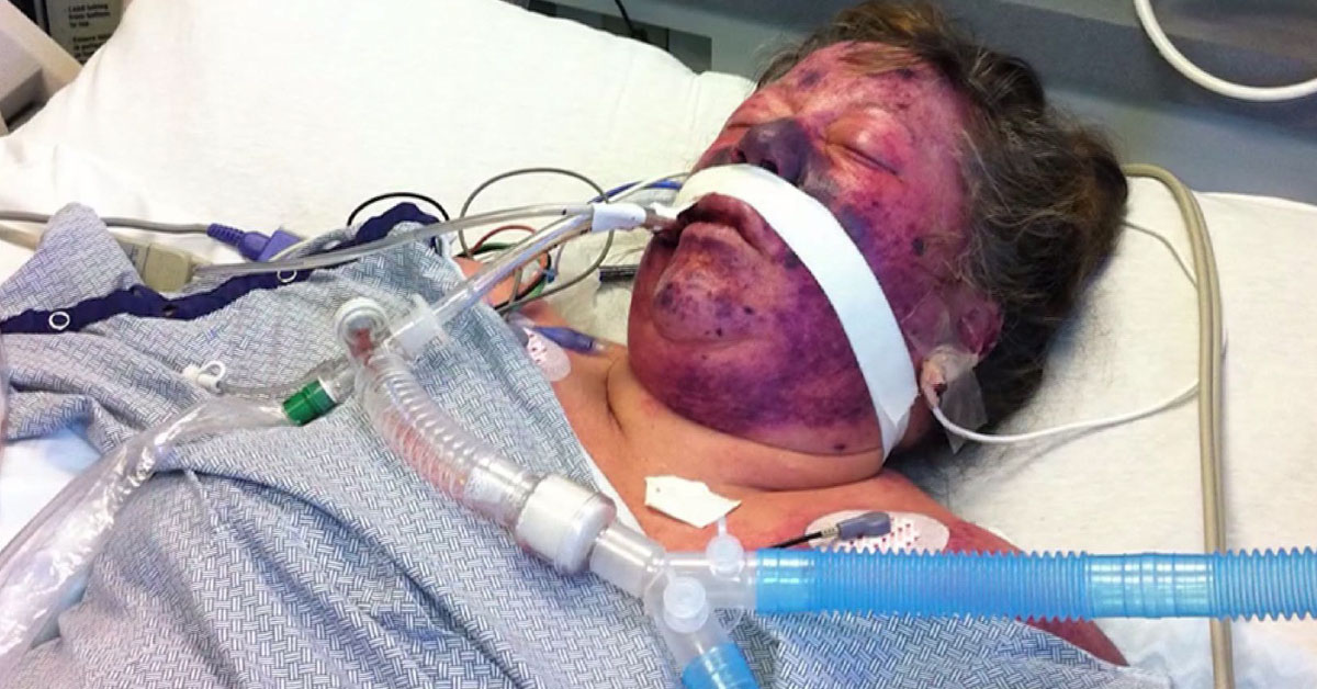 Managing Severe Sepsis In ICU