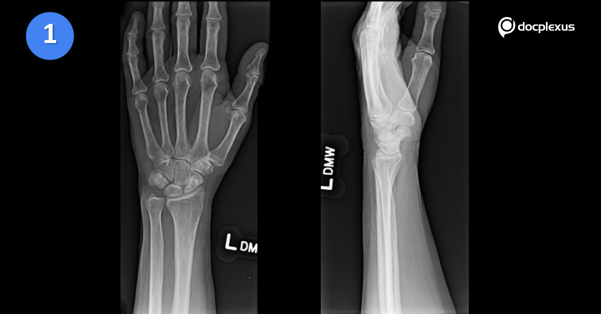 What Is Best Treatment For This Fracture?