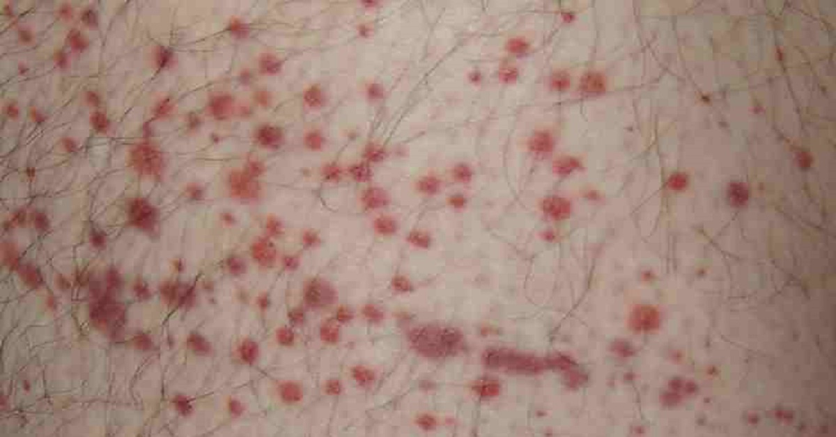 An Overview Of Purpura