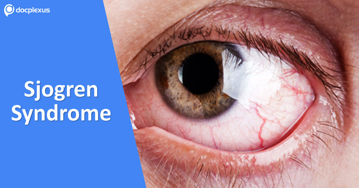 Sjogren Syndrome, Autoimmune Inflammation Of The Eye