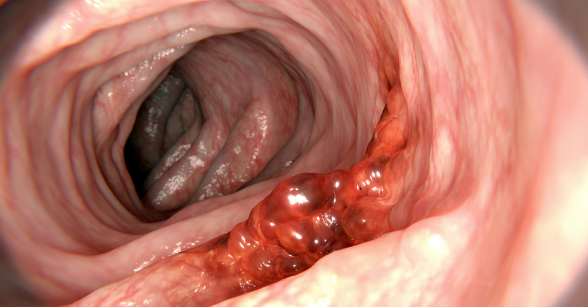 Rectal Cancer: European Society For Medical Oncology