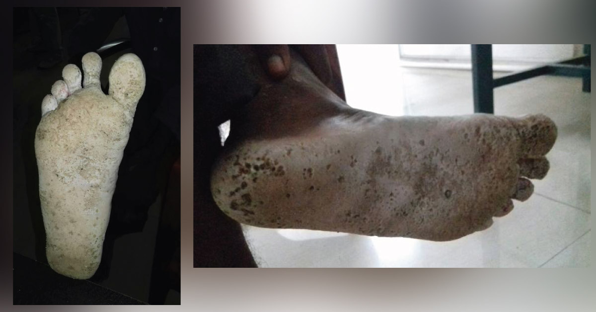 Unusual Lesions Over Soles