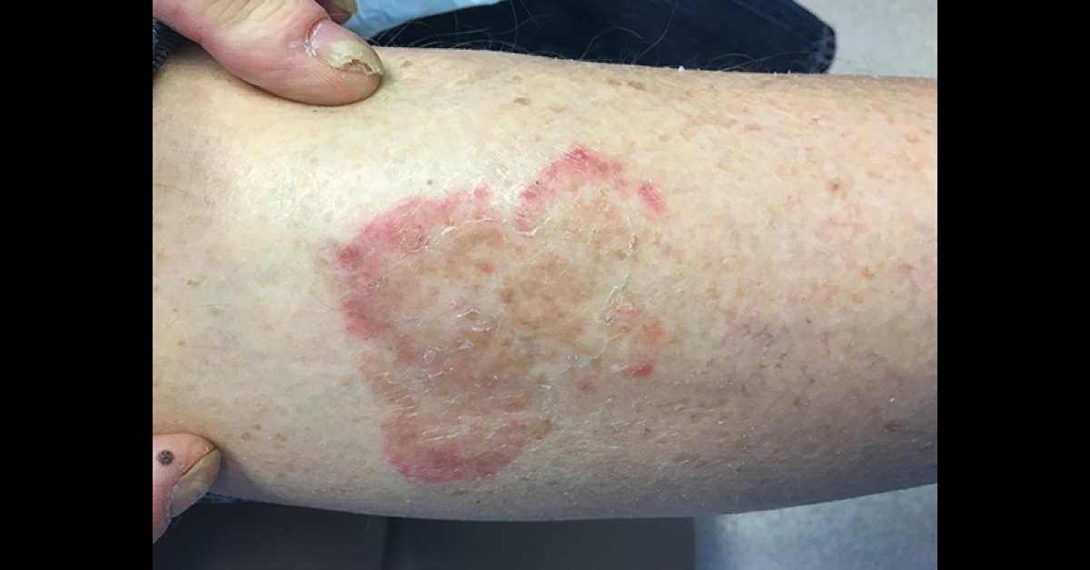 What Is This Rash?