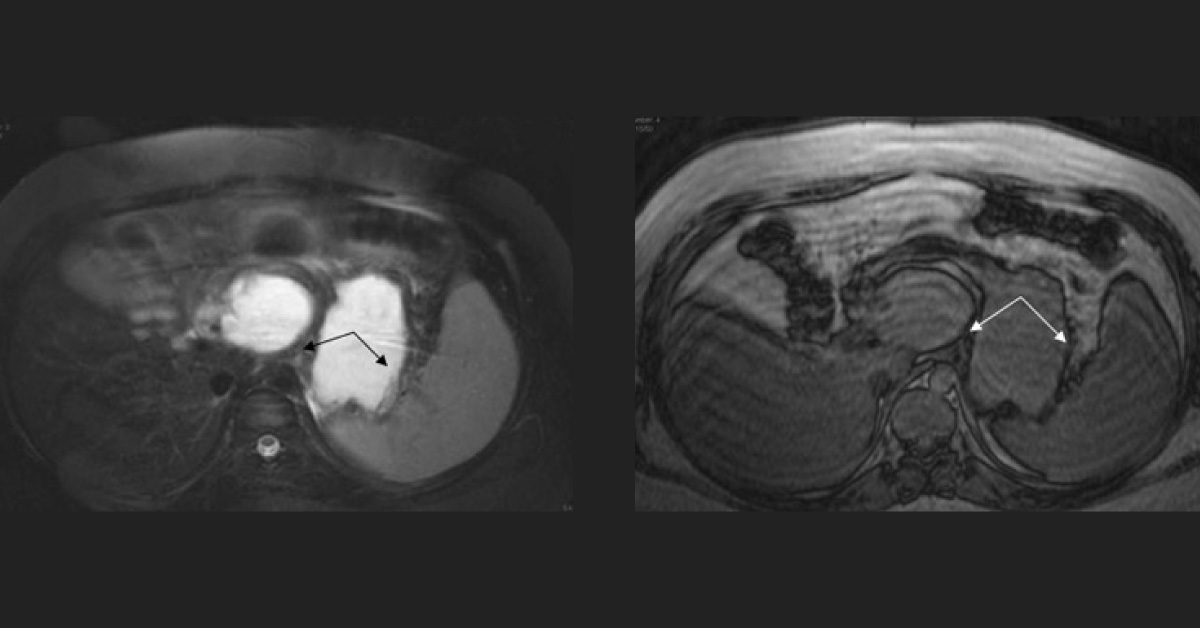 Chronic Abdominal Pain And Vomiting