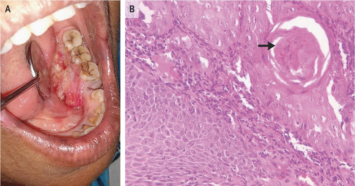Identify If This Carcinoma Of Mouth