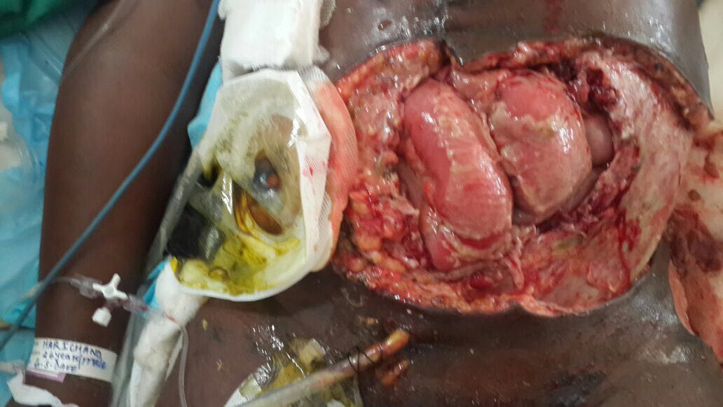 Complex Gunshot Abdominal Wall Defect, Staged Reconstruction