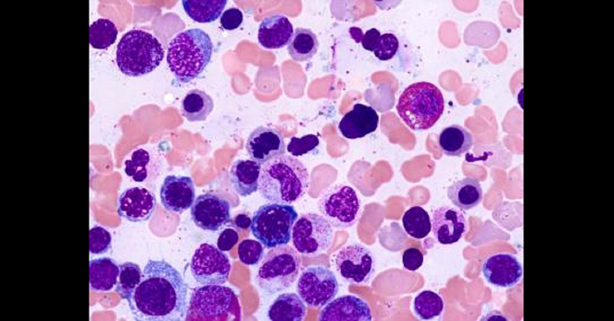 Myelodysplastic syndrome, Symptoms And Treatment