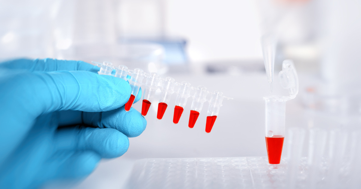 Biomarkers Can Now Predict Sepsis